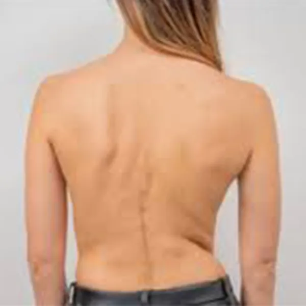 Scoliosis